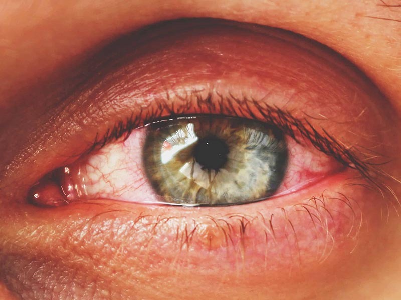 Лікування інфекційних хвороб очей