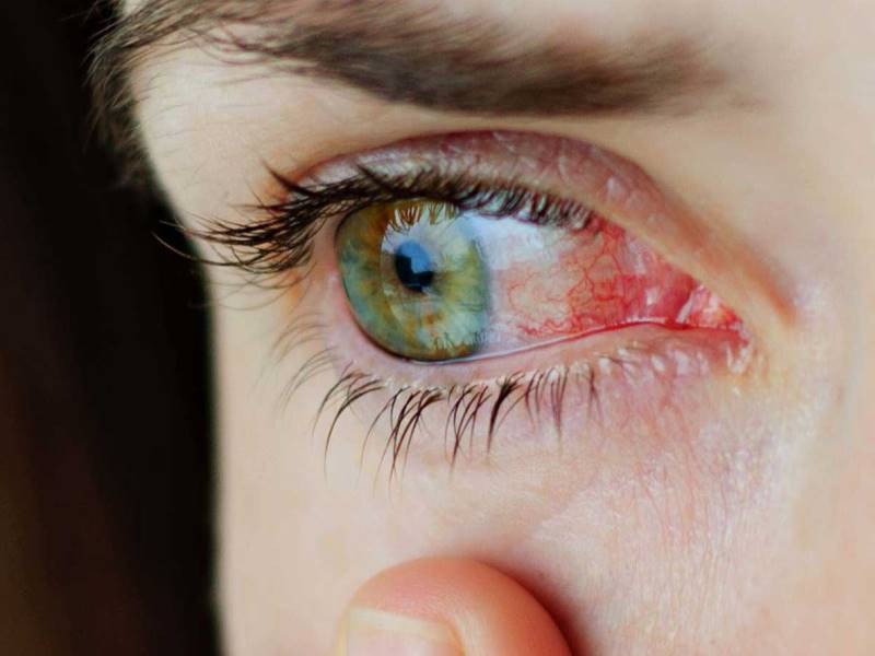 Лікування інфекційних хвороб очей